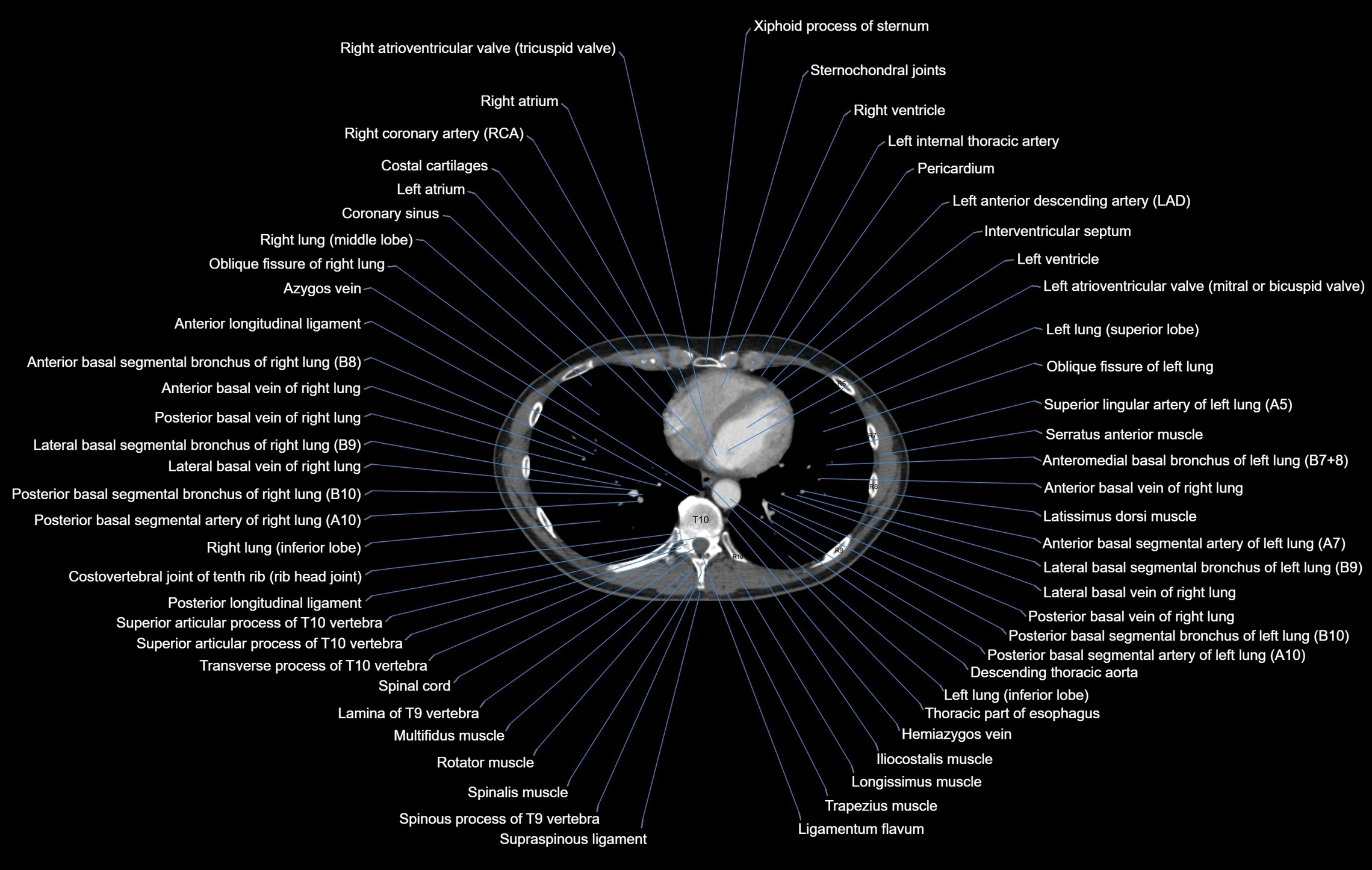CT chest (thorax) labelled axial cross sectional anatomy radiology image-00084.webp